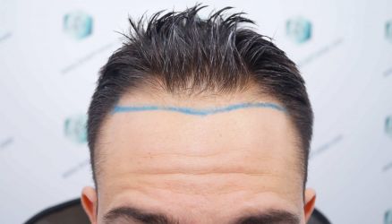 Injerto Capilar Técnica FUE Grafts 2314 (5722 Pelos) 8 13 DISENO LINEA DE INJERTO CAPILAR