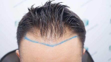 Injerto Capilar Técnica FUE Grafts 2314 (5722 Pelos) 9 14 DISENO LINEA DE INJERTO CAPILAR