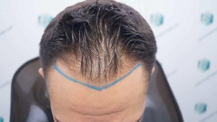 Injerto Capilar Técnica FUE Grafts 2314 (5722 Pelos) 10 15 DISENO LINEA DE INJERTO CAPILAR