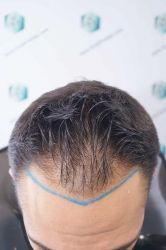 Injerto Capilar Técnica FUE Grafts 2314 (5722 Pelos) 11 16 DISENO LINEA DE INJERTO CAPILAR