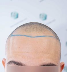 Injerto Capilar Técnica FUE Grafts 2314 (5722 Pelos) 12 17 DISENO LINEA DE INJERTO CAPILAR