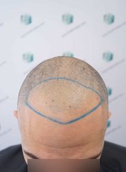 Injerto Capilar Técnica FUE Grafts 2314 (5722 Pelos) 13 18A DISENO LINEA DE INJERTO CAPILAR