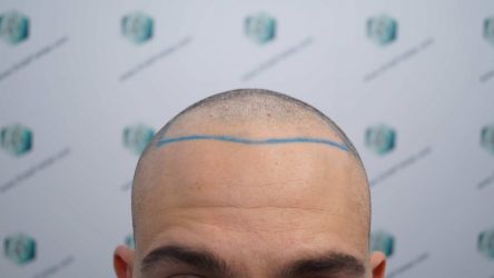 Injerto Capilar Técnica FUE Grafts 2314 (5722 Pelos) 15 24 DISENO LINEA DE INJERTO CAPILAR