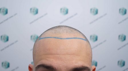Injerto Capilar Técnica FUE Grafts 2314 (5722 Pelos) 16 25 DISENO LINEA DE INJERTO CAPILAR