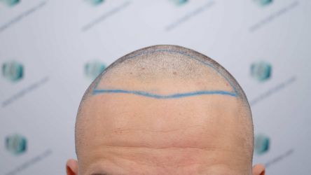 Injerto Capilar Técnica FUE Grafts 2314 (5722 Pelos) 17 28 DISENO LINEA DE INJERTO CAPILAR