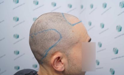 Injerto Capilar Técnica FUE Grafts 2314 (5722 Pelos) 18 30 DISENO LINEA DE INJERTO CAPILAR