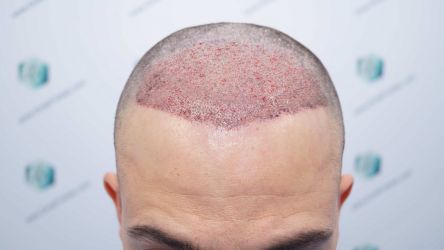 Injerto Capilar Técnica FUE Grafts 2314 (5722 Pelos) 21 35 TRASPLANTE CAPILAR