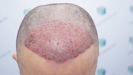 Injerto Capilar Técnica FUE Grafts 2314 (5722 Pelos) 23 36A TRASPLANTE CAPILAR