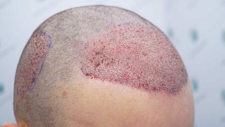 Injerto Capilar Técnica FUE Grafts 2314 (5722 Pelos) 24 37 TRASPLANTE CAPILAR