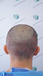 Injerto Capilar Técnica FUE Grafts 2314 (5722 Pelos) 26 39 TRASPLANTE CAPILAR
