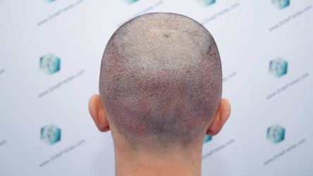 Injerto Capilar Técnica FUE Grafts 2314 (5722 Pelos) 27 40 TRASPLANTE CAPILAR