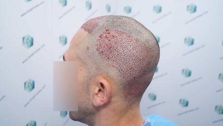 Injerto Capilar Técnica FUE Grafts 2314 (5722 Pelos) 29 42 TRASPLANTE CAPILAR