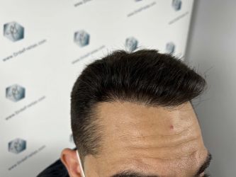 Injerto Capilar Técnica FUE Grafts 2314 (5722 Pelos) 30 45 RESULTADOS 12 MESES