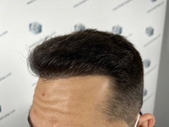 Injerto Capilar Técnica FUE Grafts 2314 (5722 Pelos) 31 46 RESULTADOS 12 MESES