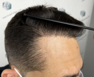 Injerto Capilar Técnica FUE Grafts 2314 (5722 Pelos) 32 48A RESULTADOS 12 MESES