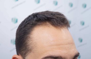 Injerto Capilar Técnica FUE Grafts 2314 (5722 Pelos) 4 5 ANTES DEL TRASPLANTE CAPILAR