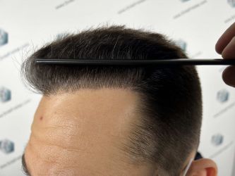 Injerto Capilar Técnica FUE Grafts 2314 (5722 Pelos) 34 50 RESULTADOS 12 MESES