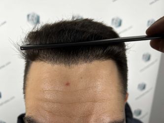 Injerto Capilar Técnica FUE Grafts 2314 (5722 Pelos) 35 51 RESULTADOS 12 MESES
