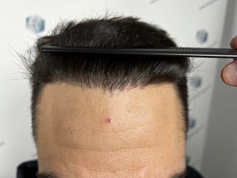 Injerto Capilar Técnica FUE Grafts 2314 (5722 Pelos) 36 53 RESULTADOS 12 MESES