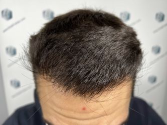 Injerto Capilar Técnica FUE Grafts 2314 (5722 Pelos) 37 55 RESULTADOS 12 MESES