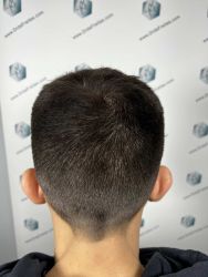 Injerto Capilar Técnica FUE Grafts 2314 (5722 Pelos) 38 56 RESULTADOS 12 MESES
