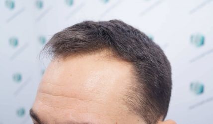 Injerto Capilar Técnica FUE Grafts 2314 (5722 Pelos) 5 6 ANTES DEL TRASPLANTE CAPILAR