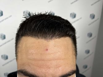 Injerto Capilar Técnica FUE Grafts 2314 (5722 Pelos) 39 60 RESULTADOS 12 MESES