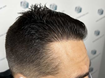 Injerto Capilar Técnica FUE Grafts 2314 (5722 Pelos) 40 61 RESULTADOS 12 MESES