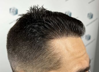 Injerto Capilar Técnica FUE Grafts 2314 (5722 Pelos) 41 62B RESULTADOS 12 MESES