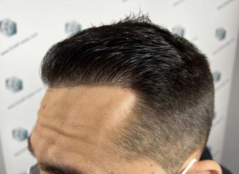 Injerto Capilar Técnica FUE Grafts 2314 (5722 Pelos) 42 63 RESULTADOS 12 MESES