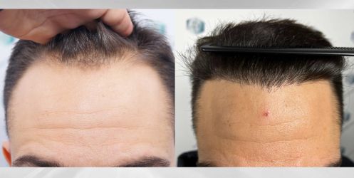 Injerto Capilar Técnica FUE Grafts 2314 (5722 Pelos) 43 68 COMPARATIVAS