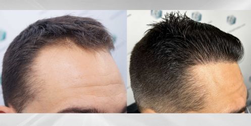 Injerto Capilar Técnica FUE Grafts 2314 (5722 Pelos) 44 69 COMPARATIVAS