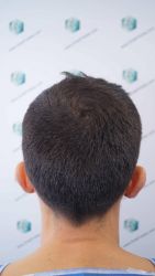 Injerto Capilar Técnica FUE Grafts 2314 (5722 Pelos) 6 7 ANTES DEL TRASPLANTE CAPILAR