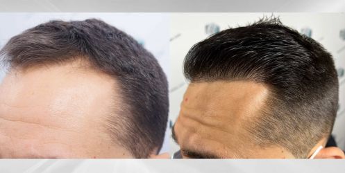 Injerto Capilar Técnica FUE Grafts 2314 (5722 Pelos) 45 70 COMPARATIVAS