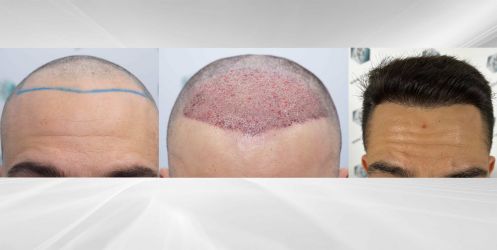 Injerto Capilar Técnica FUE Grafts 2314 (5722 Pelos) 46 71 COMPARATIVAS