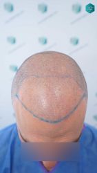 17 DISENO LINEA INJERTO CAPILAR