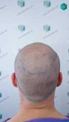20 DISENO LINEA INJERTO CAPILAR