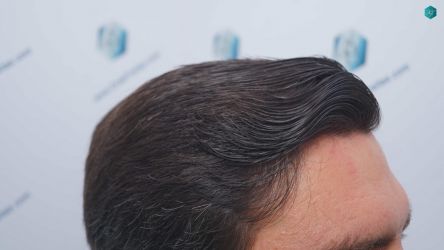 55 RESULTADOS A LOS 12 MESES