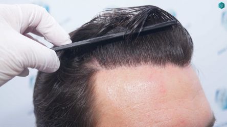 60 RESULTADOS A LOS 12 MESES