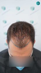10 DISENO ANTES DEL TRASPLANTE CAPILAR