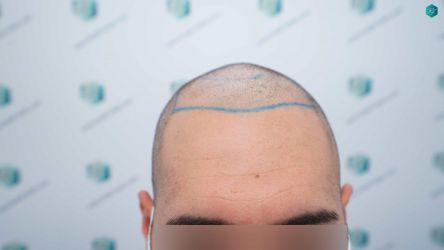 13 DISENO ANTES DEL TRASPLANTE CAPILAR
