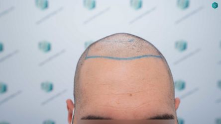 14 DISENO ANTES DEL TRASPLANTE CAPILAR