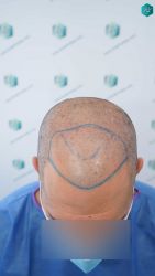 15 DISENO ANTES DEL TRASPLANTE CAPILAR