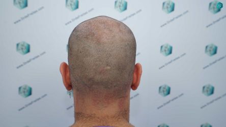 16 DISENO ANTES DEL TRASPLANTE CAPILAR