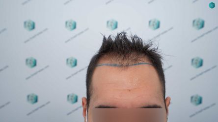 9 DISENO ANTES DEL TRASPLANTE CAPILAR