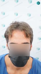 Injerto Capilar Técnica FUE Grafts 2519 (5393 Pelos) 1 1 ANTES DEL TRASPLANTE CAPILAR