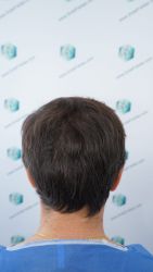 Injerto Capilar Técnica FUE Grafts 3060 (6835 Pelos) 9 10 ANTES DEL TRASPLANTE CAPILAR