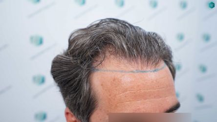 Injerto Capilar Técnica FUE Grafts 2519 (5393 Pelos) 11 10 DISENO LINEA DE INJERTO