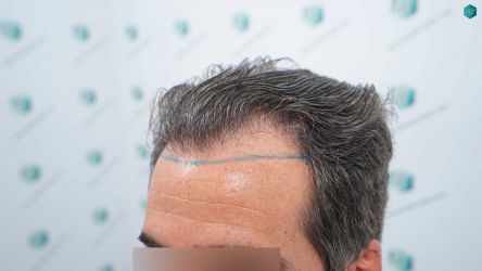 Injerto Capilar Técnica FUE Grafts 2519 (5393 Pelos) 12 11 DISENO LINEA DE INJERTO