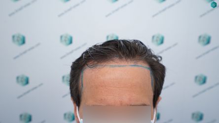 Injerto Capilar Técnica FUE Grafts 3060 (6835 Pelos) 10 12 DISENO LINEA DE INJERTO 1